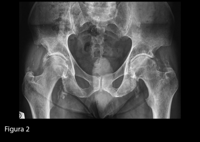 Radiografia del bacino in proiezione antero-posteriore. Si evidenziano calcificazioni a carico delle entesi del grande trocantere e delle branche ischio-pubiche bilateralmente, nonché a livello delle articolazioni coxo-femorali e della sinfisi pubica.